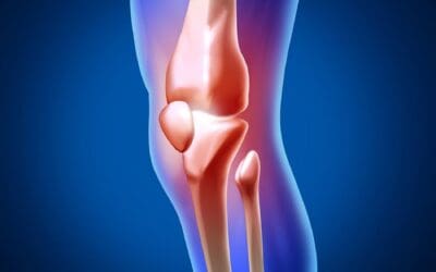 Arthroscopic Meniscectomy/Chondral Debridement