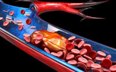 Why We Prescribe a DVT (Deep Vein Thrombosis) Scan After Joint Replacements